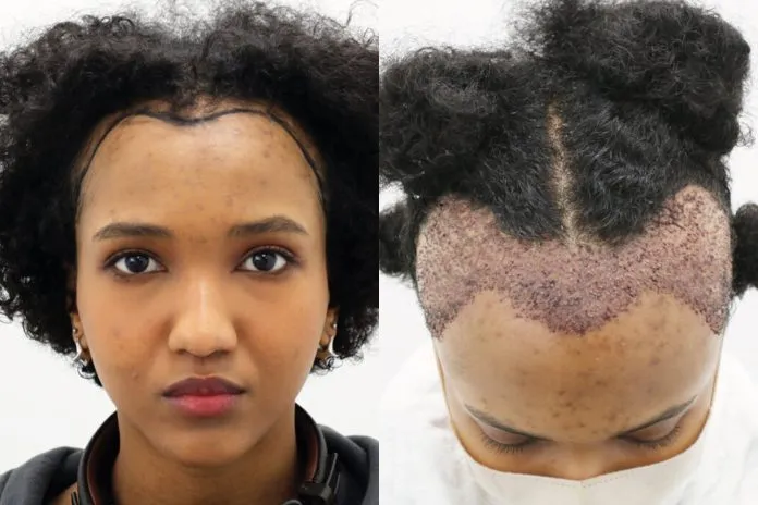 Facial & Hair Planting