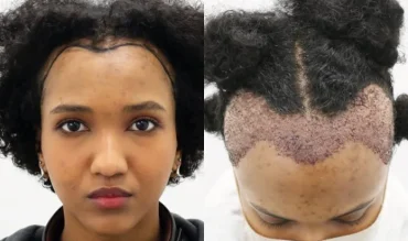 Facial & Hair Planting