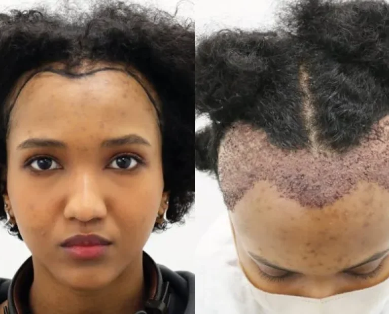 Facial & Hair Planting